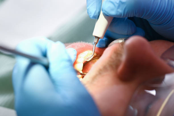 Best Emergency Wisdom Teeth Removal in Wheaton, MN
